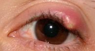 Chalazion: Vs. Stye, Causes, Symptoms, Treatment, and More